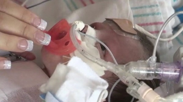 بالصور والفيديو..طفلة أميريكة تولد بقلب خارج صدرها
